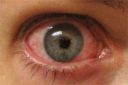 Red Disturbed Eye